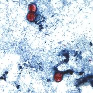 Cyclospora_Outbreak__9611 This undated photo taken through a microscope provided by the CDC shows Cyclospora cayetanensis oocysts found in a fresh stool sample which had been prepared with a formalin solution and stained with safranin. (CDC via AP)