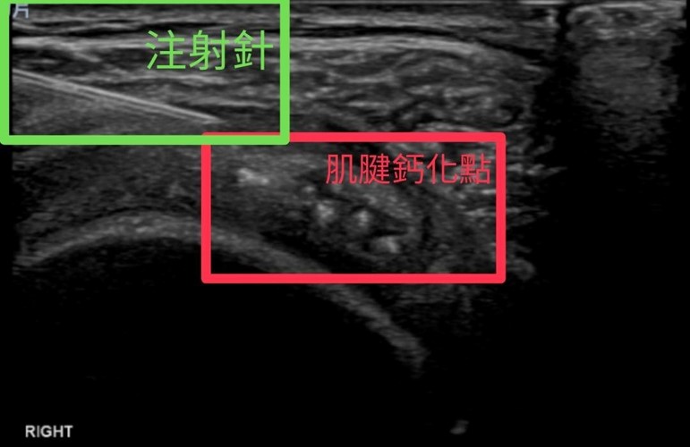 認識鈣化性肌腱炎